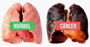 cancer